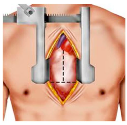 sternotomie chirurgie cardiaque clinique saint augustin bordeaux