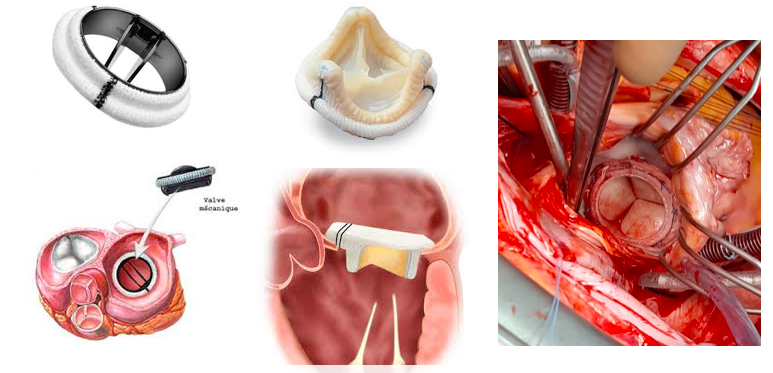 Valve mitrale - Chirurgie cardiaque - Clinique Saint-Augustin, Bordeaux