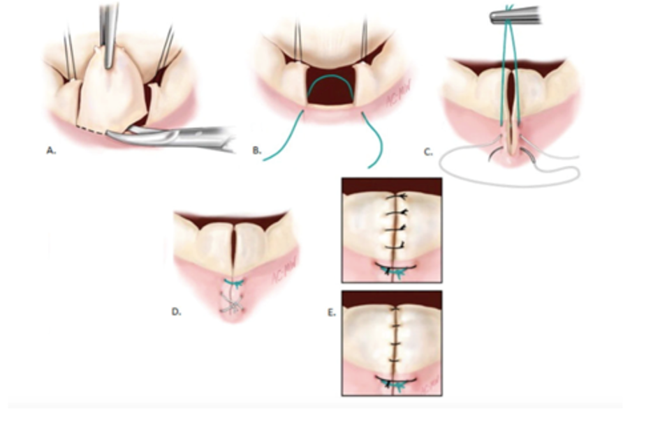 Plastie de la valve mitrale - Cardiologie et sport