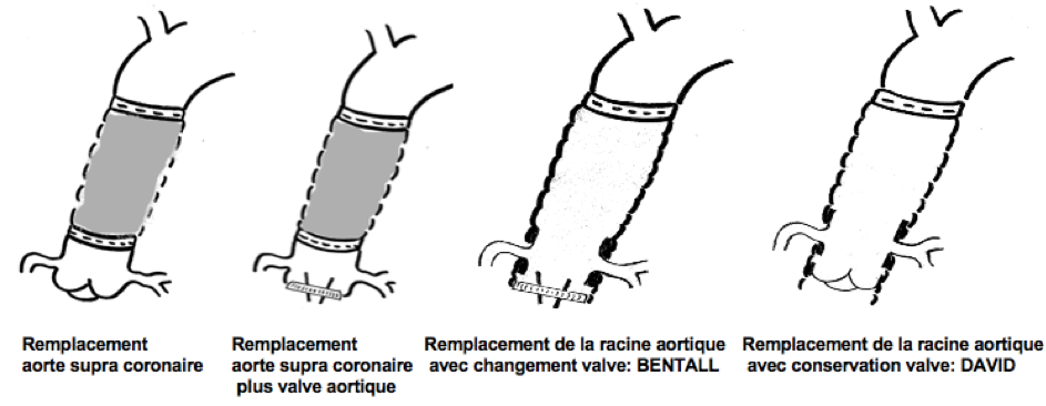 Différentes possibilités de chirurgie 