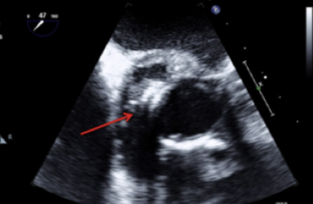 Echographie d'une endocardite