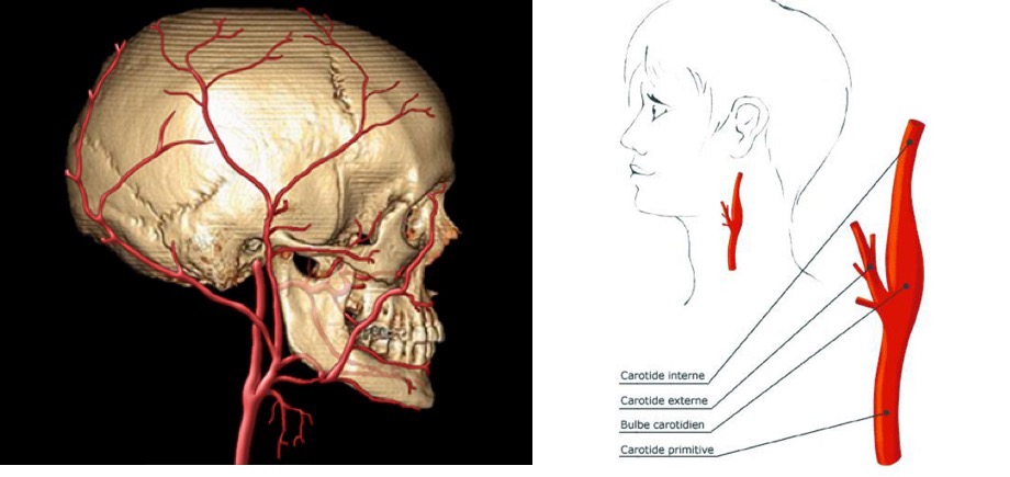 Sténose carotidienne : examen de l'artère carotide par doppler