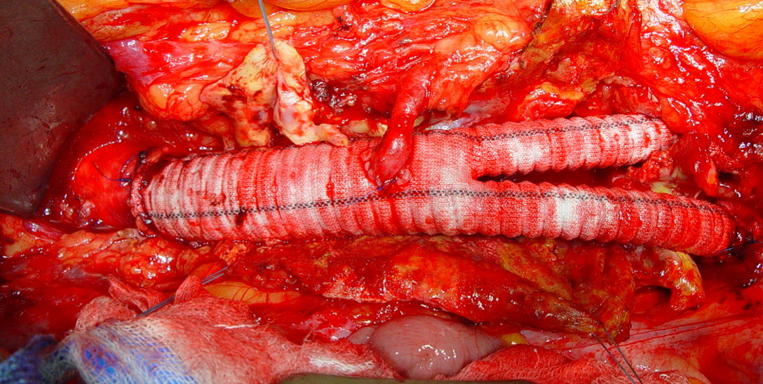 Aorte abdominale sous rénale - Chirurgie cardiaque -