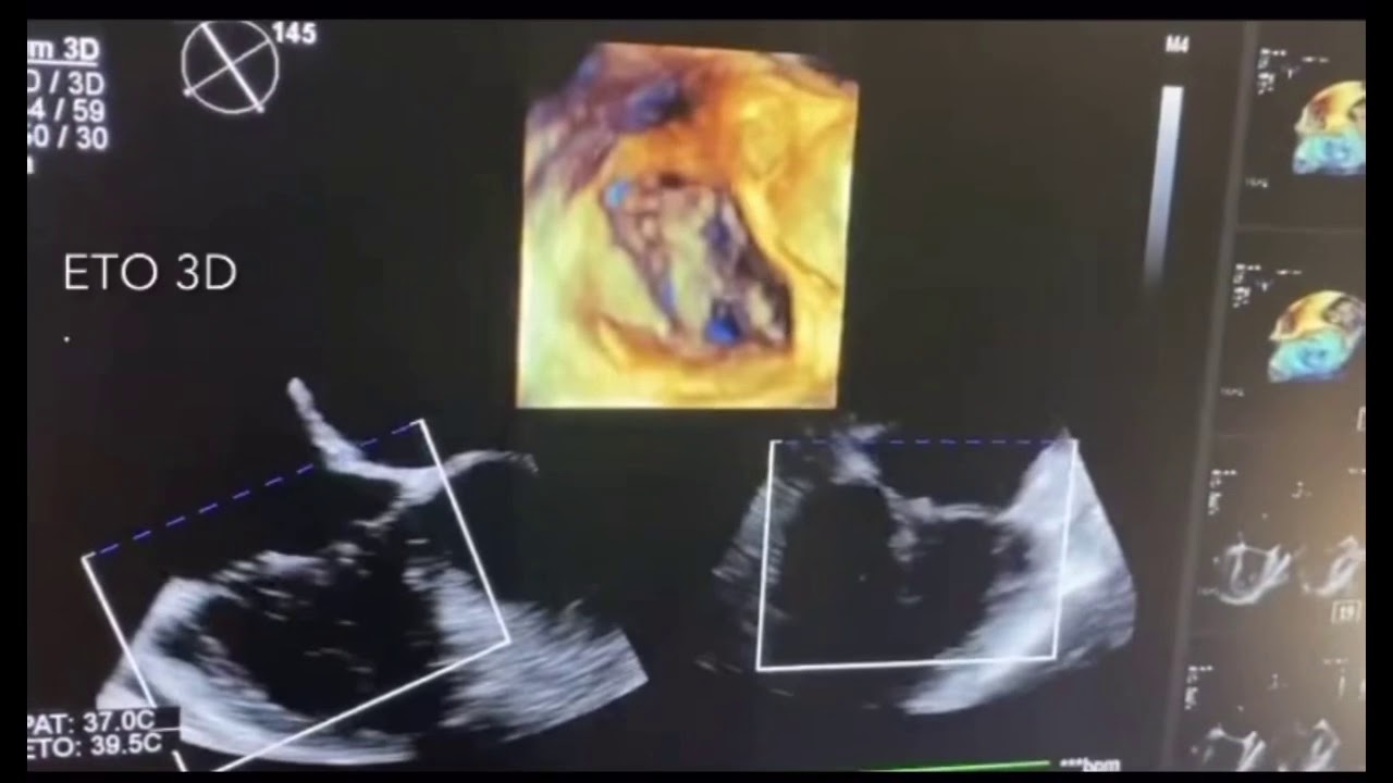 Valve tricuspide Chirurgie cardiaque Clinique SaintAugustin, Bordeaux